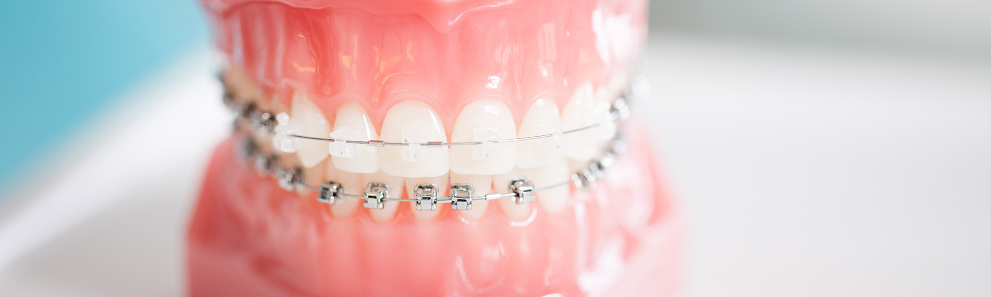 Exploring Your Perfect Smile: Understanding Your Braces Options