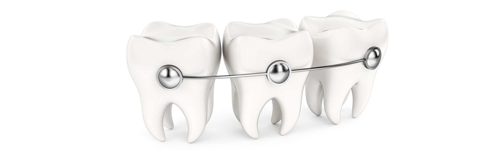 Braces in Santa Barbara CA
