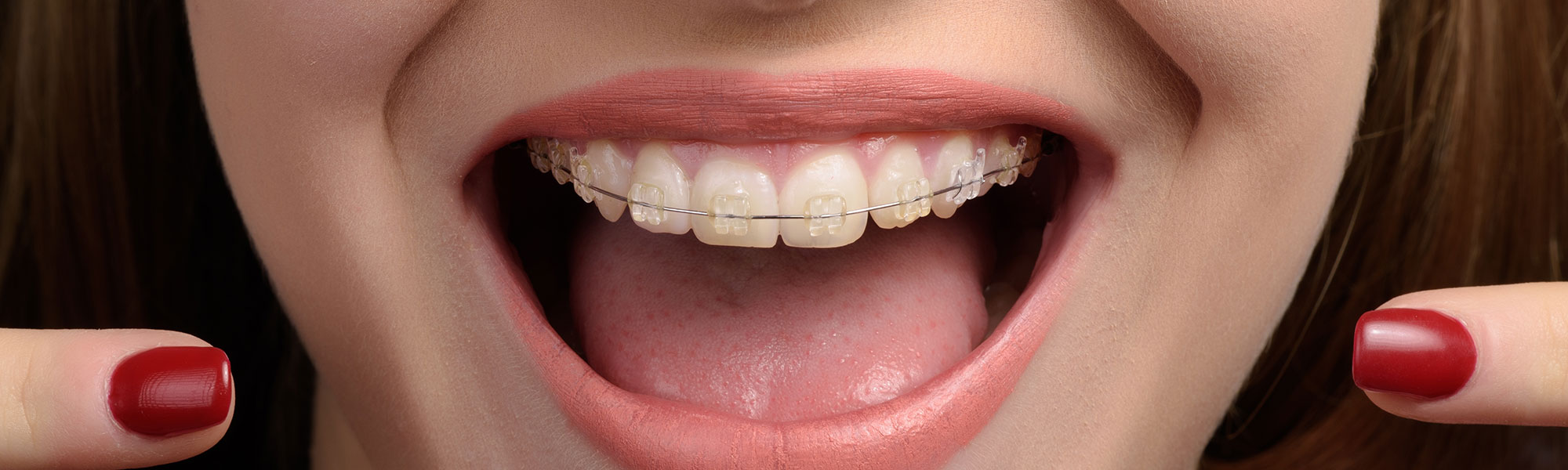 Porcelian Ceramic Braces Santa Barbara CA