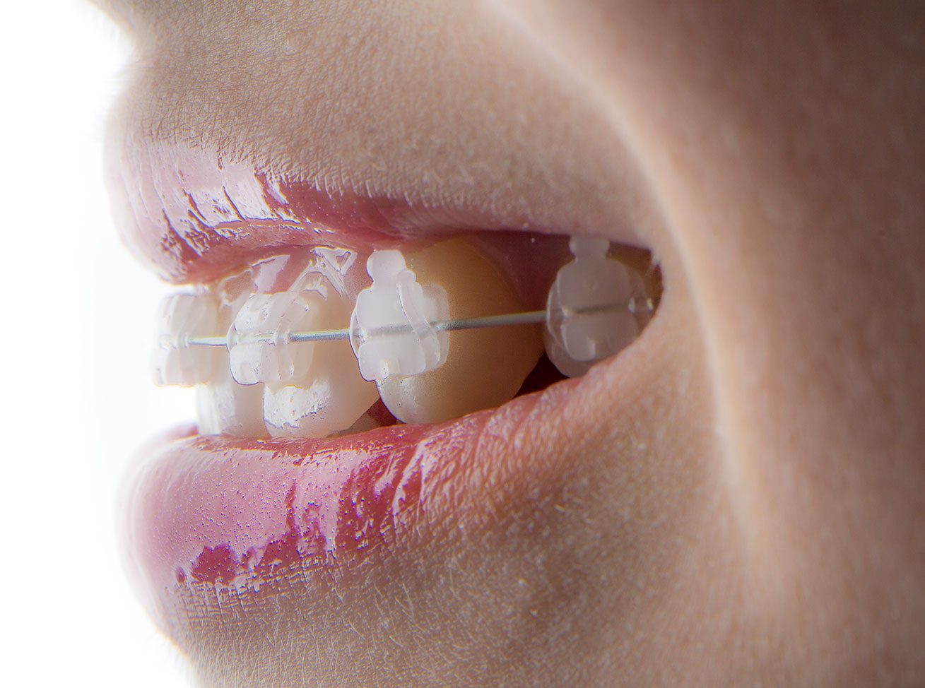 Ceramic Braces Santa Barbara CA