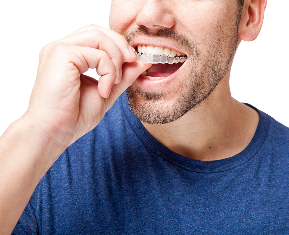 Invisalign Clear Braces Santa Barbara CA