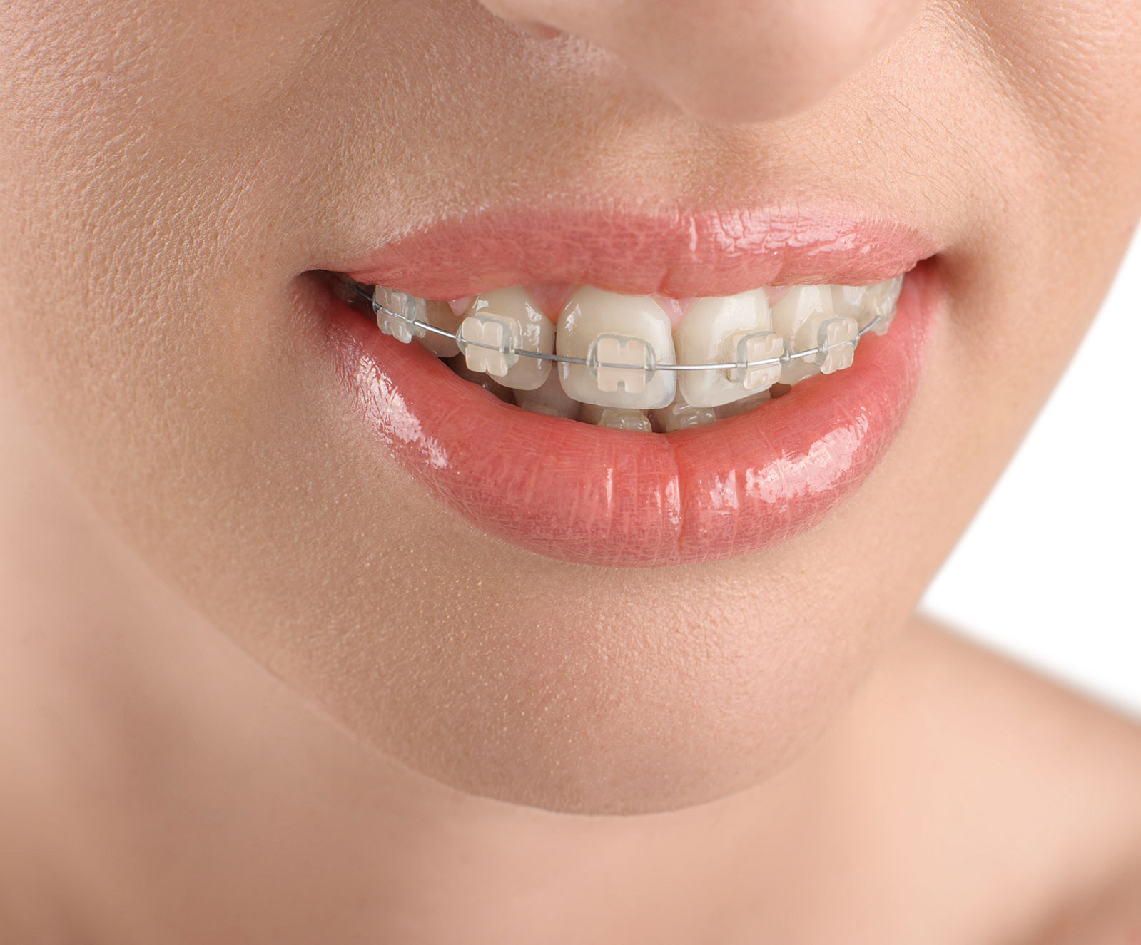 Porcelain Braces Near Me Santa Barbara